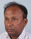 Before Hair Transplant&nbsp;Front